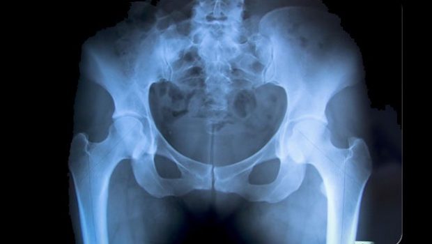 Έρευνα: Αυξημένος ο κίνδυνος κατάγματος στο ισχίο για τις vegan γυναίκες