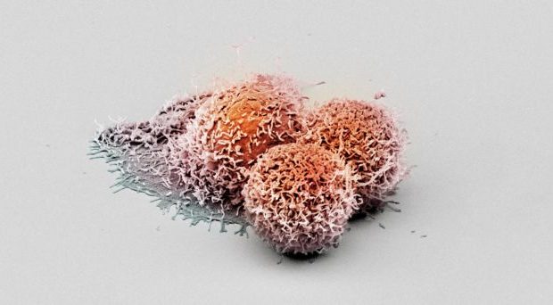 Καρκίνος της μήτρας: Νέο τεστ θα μπορούσε να μειώσει το χρόνο διάγνωσης