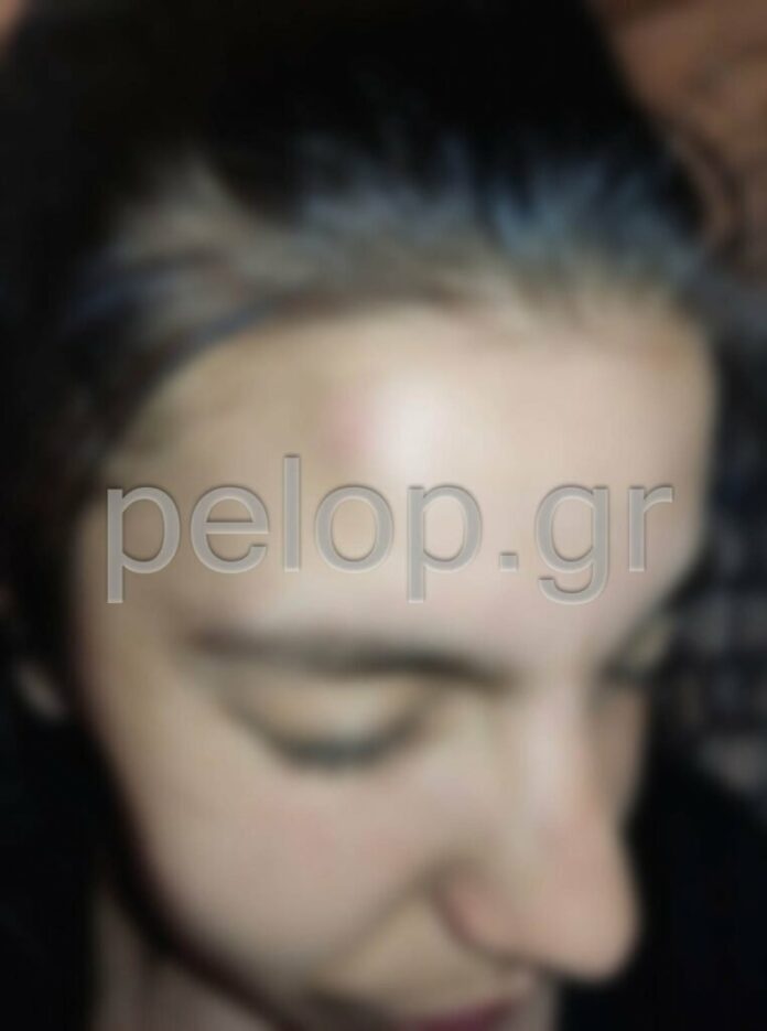 Πάτρα: Ξυλοδαρμός 16χρονης από τον σύντροφό της