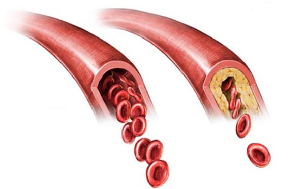 Οικογενής υπερχοληστερολαιμία: Μόνο το 20% των ασθενών γνωρίζει ότι πάσχει