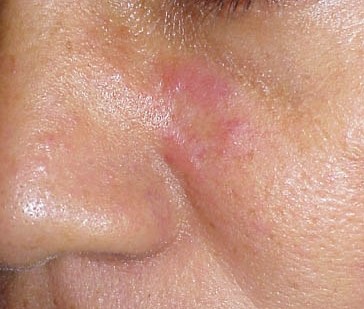 Στις κυτταρικές θεραπείες οι ελπίδες για αυτοάνοσα νοσήματα