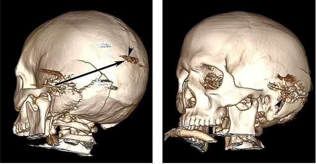 Κρήτη: Απίστευτη τύχη για αγρότη που επέζησε από πυροβολισμό στο κεφάλι