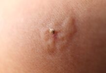 Πότε ένα τσίμπημα μπορεί να οδηγήσει στο θάνατο – Τι είναι το αλλεργικό σοκ και τι πρέπει να προσέξετε